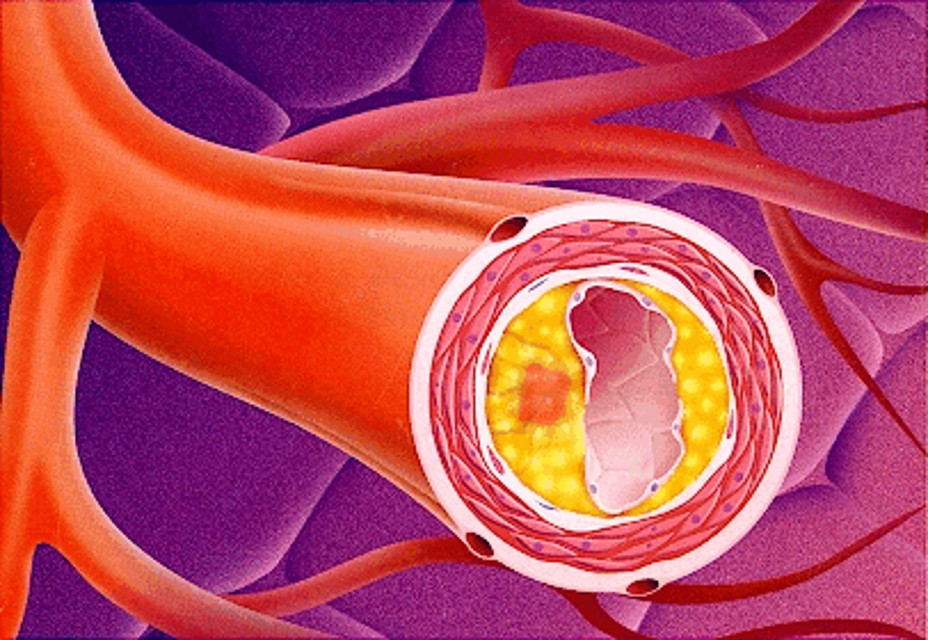Расширение артериальных сосудов. Атеросклероз (закупорка кровеносных сосудов). Атеросклероз аорты и сосудов. Утолщение стенок артерий. Жировые бляшки в сосудах.